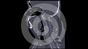 CT C-Spine or Cervical spine sagittal view