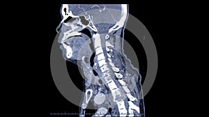 CT C-Spine or Cervical spine sagittal view