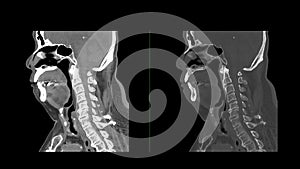 CT C-Spine or Cervical spine sagittal view