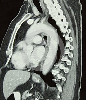 CT of Chest