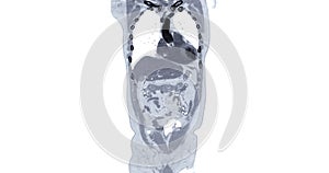 CT Chest and Abdomen with injection contrast media coronal view for diagnosis chest and  abdominal pain photo