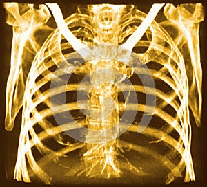 CT of chest bones