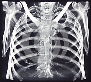 CT of chest bones