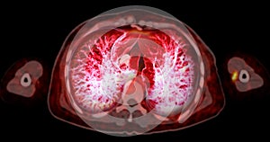 CT Chest or Lung 3d rendering image  showing Trachea and lung in respiratory system