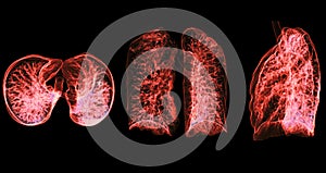CT Chest or Lung 3d rendering image  showing Trachea and lung in respiratory system