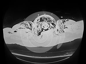 CT Chest - pneumomediastinum and subcutaneous emphysema w interstitial pneumonia photo