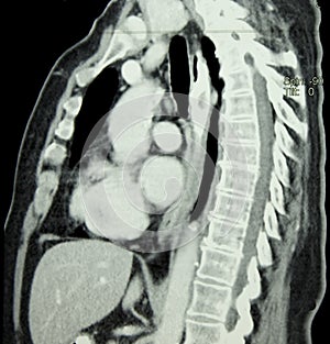 CT of Chest and Spine