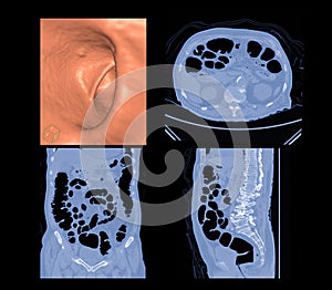 CT colonography  3D and 2D Axial,sagittal ,coronal plane .