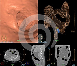 CT colonography compare 2D Axial,sagittal ,coronal plane  and 3D rendering image.