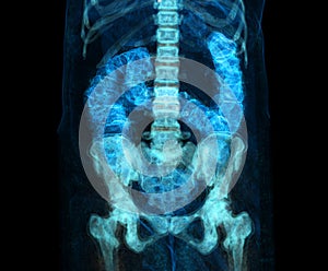 CT colonography  or CT Scan of Colon 3D Rendering image  for screening colorectal cancer. Check up Screening Colon Cancer