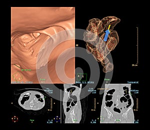 CT colonography is highly sensitive for colorectal cancer, 3D rendering image