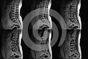 CT Computed tomography scans of human spine on a ultrasound computer monitor. Part two