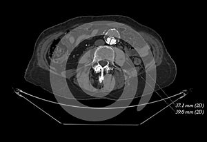 CT of contrasted aorta dissection measured