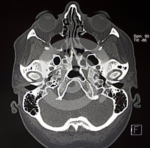 CT of cranial bones