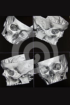 CT of head bones