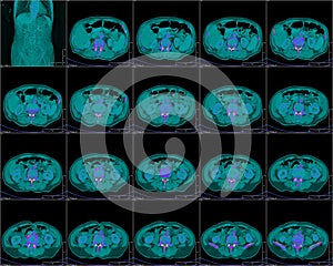 CT image - chest