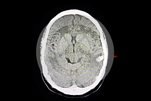 CT intracerebral hemorrhage