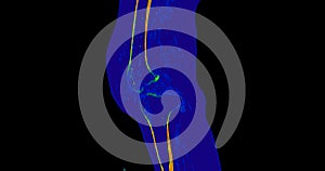 CT Knee or CT Scan image of knee joint sagittal view