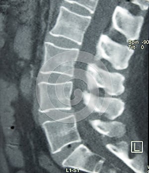 CT of Lumbar Spine