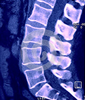 CT of Lumbar Spine, Sagittal plane