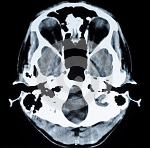 CT photo of human brain