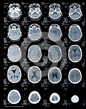 Ct scan