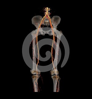 CT SCAN 2D and 3D rendering of lower extremity.