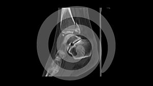 Ct scan 3D Ankle joint views A woman 64 year old accident showing Spiral fracture of distal fibula at level of syndesmosis, with