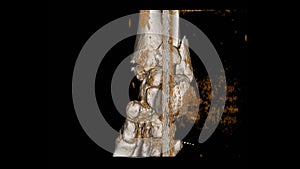 Ct scan 3D Ankle joint views A woman 64 year old accident showing Spiral fracture of distal fibula at level of syndesmosis, with