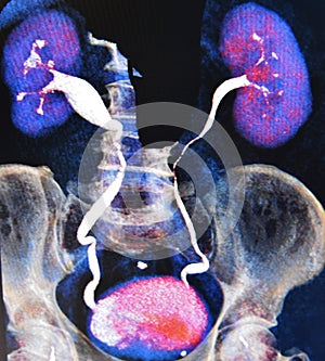 Ct scan 3d ct urography kidneys bladder colorful