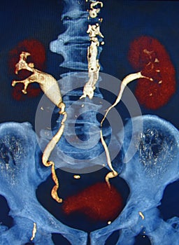 Ct scan 3d ct urography kidneys bladder colorful