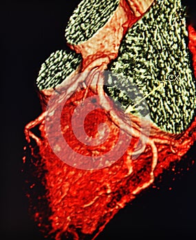 Ct scan 3d heart angiography colorful