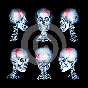 CT scan and 3D image of head and cervical spine. Use this image for stroke , skull fracture , neurological condition .