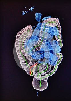 Ct scan 3d large small intestine coloreful