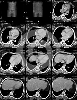 CT scan of abdomen photo