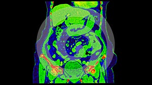 CT scan of  Abdomen  coronal view with injection contrast media with green color mode coronal view for diagnosis  abdominal photo
