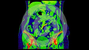 CT scan of  Abdomen  coronal view with injection contrast media with green color mode coronal view for diagnosis  abdominal photo
