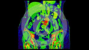 CT scan of  Abdomen  coronal view with injection contrast media with green color mode coronal view for diagnosis  abdominal photo