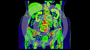 CT scan of  Abdomen  coronal view with injection contrast media with green color mode coronal view for diagnosis  abdominal photo