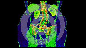 CT scan of  Abdomen  coronal view with injection contrast media with green color mode coronal view for diagnosis  abdominal photo