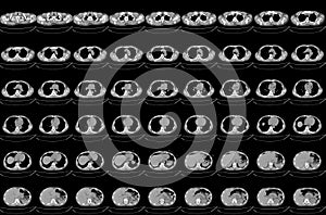 CT scan abdomen of the patient`s Diffuse bronchial wall thickening and mild peribronchial infiltration at the superior segment of