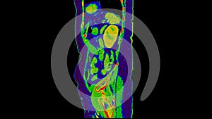 CT scan of  Abdomen  sagittal view with injection contrast media with green color mode coronal view for diagnosis  abdominal photo
