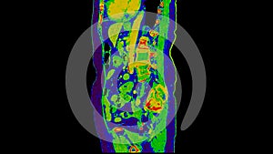 CT scan of  Abdomen  sagittal view with injection contrast media with green color mode coronal view for diagnosis  abdominal photo