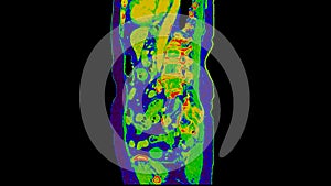 CT scan of  Abdomen  sagittal view with injection contrast media with green color mode coronal view for diagnosis  abdominal photo