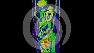 CT scan of  Abdomen  sagittal view with injection contrast media with green color mode coronal view for diagnosis  abdominal photo