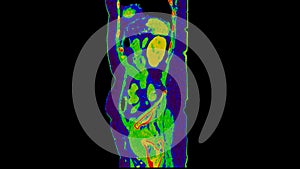 CT scan of  Abdomen  sagittal view with injection contrast media with green color mode coronal view for diagnosis  abdominal photo