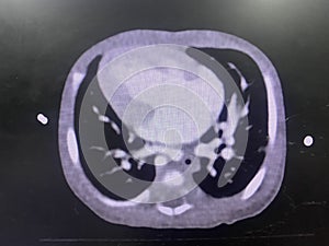 CT scan angiogram show dextrocardia the congenital heart disease photo