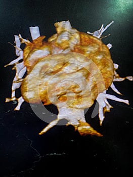 CT scan angiogram show dextrocardia the congenital heart disease photo