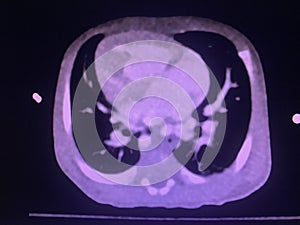 CT scan angiogram show dextrocardia the congenital heart disease photo