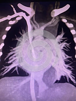 CT scan angiogram show dextrocardia the congenital heart disease photo